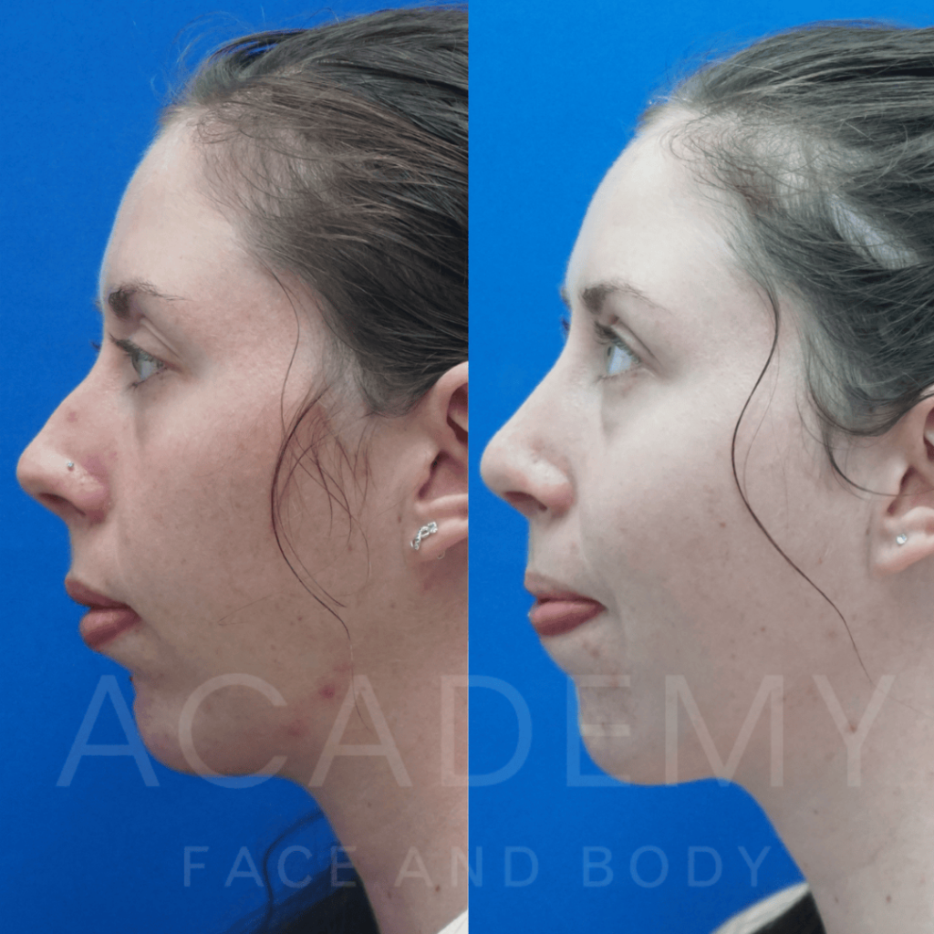 academy-face-and-body-NOSE-17