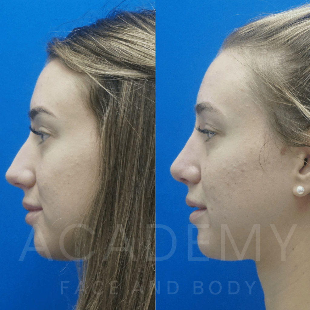 academy-face-and-body-NOSE-18