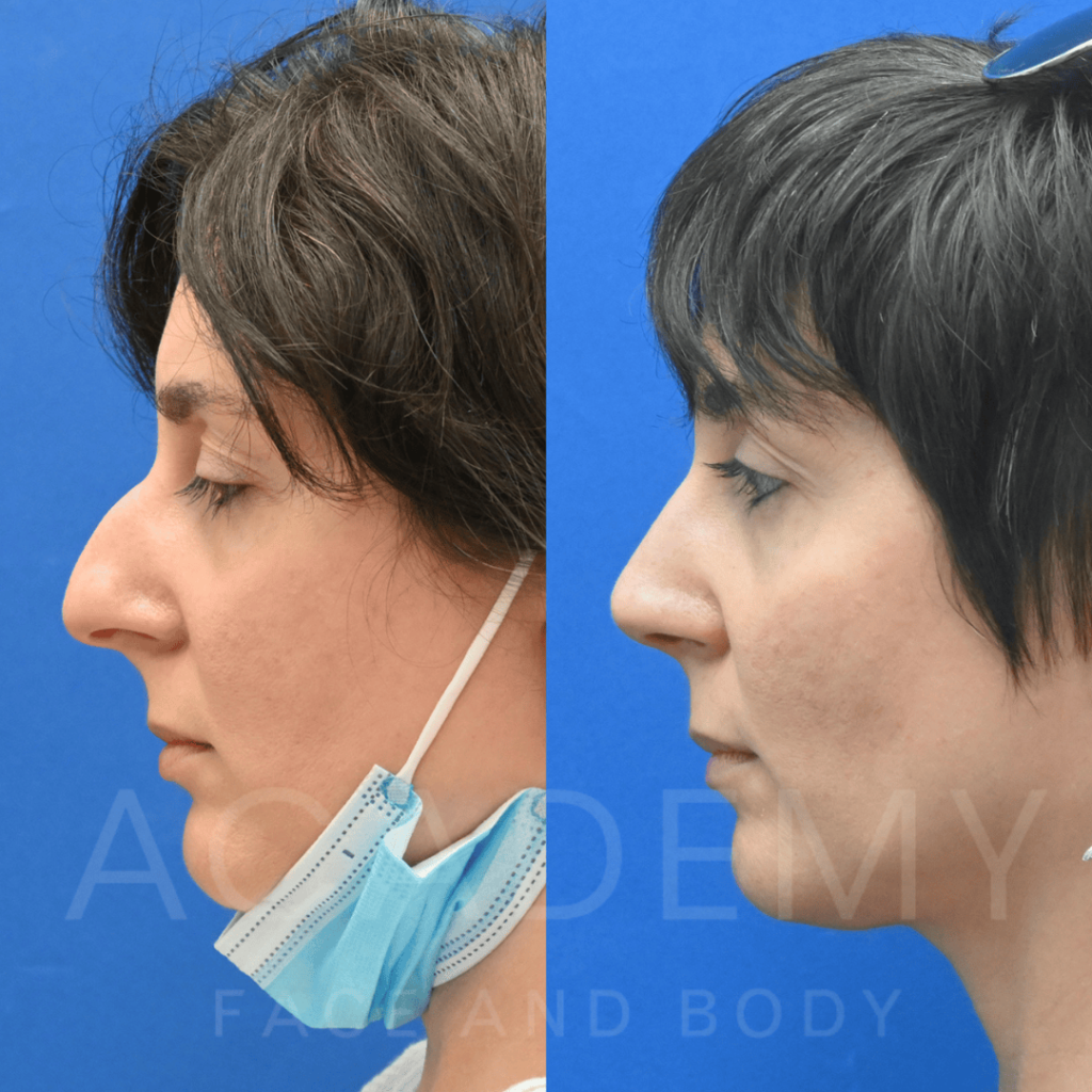 academy-face-and-body-NOSE-20