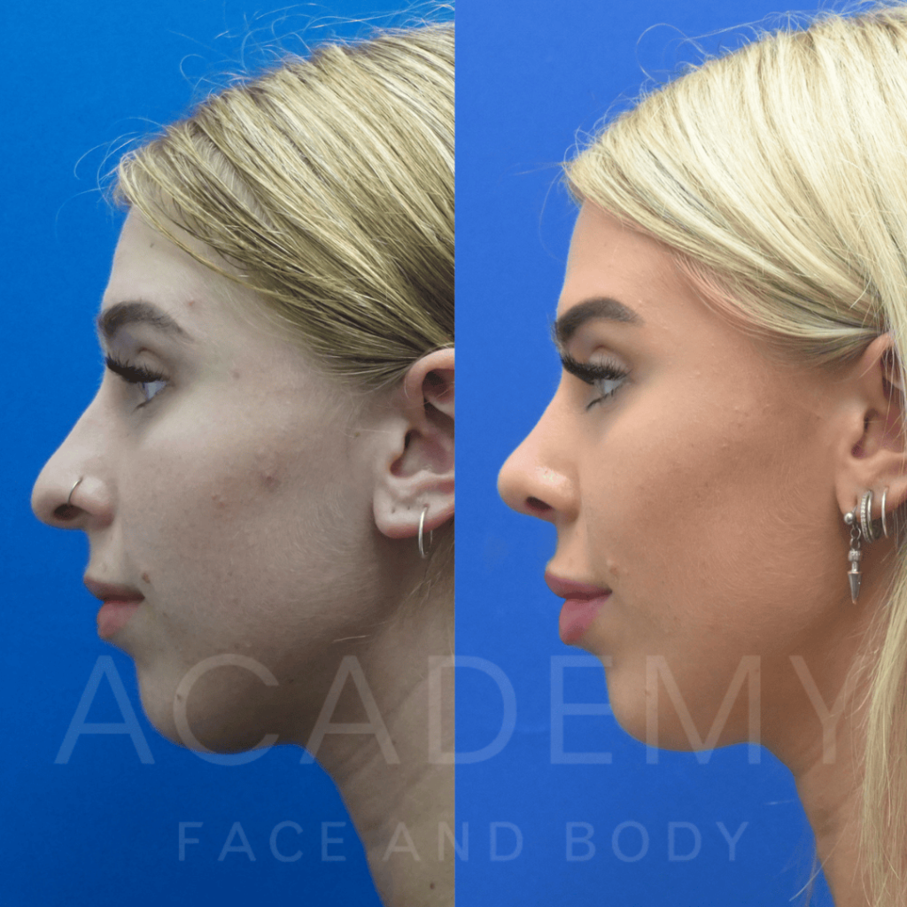 academy-face-and-body-NOSE-21