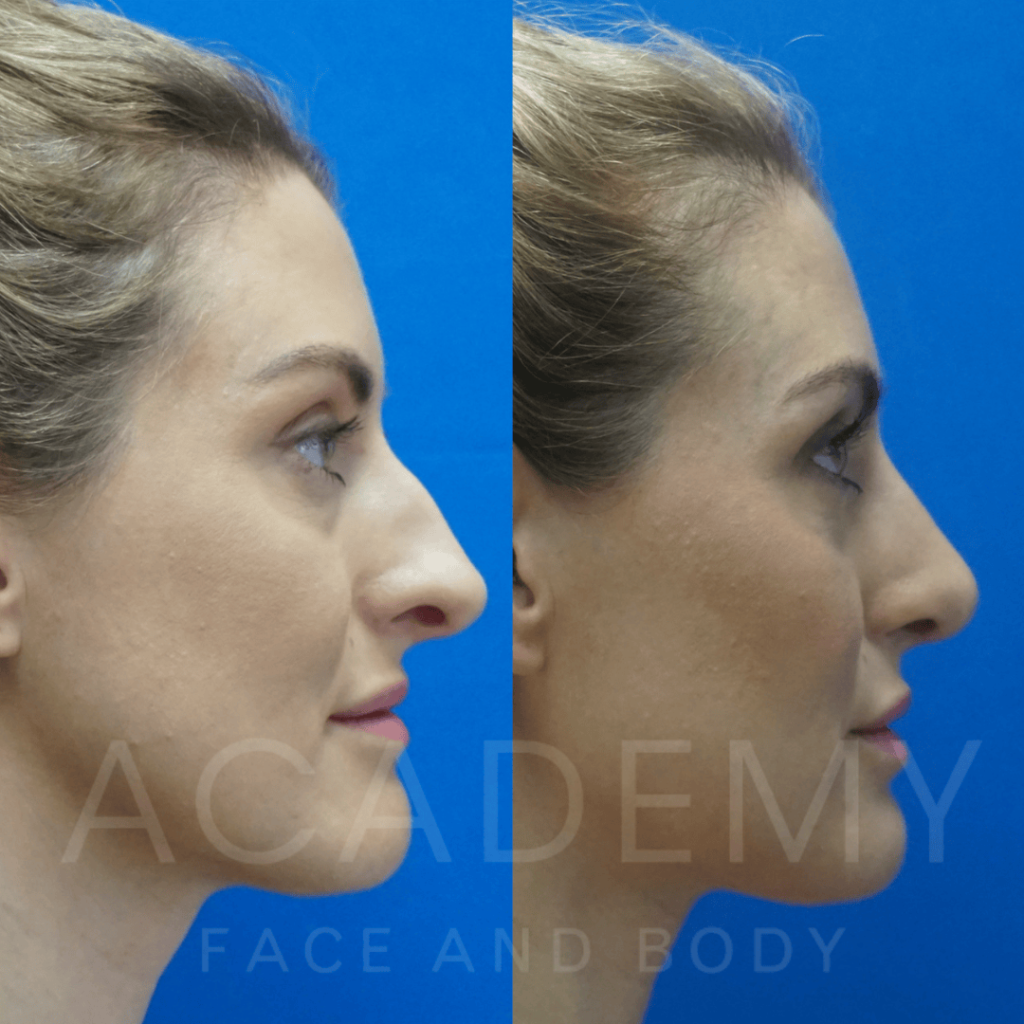 academy-face-and-body-NOSE-22