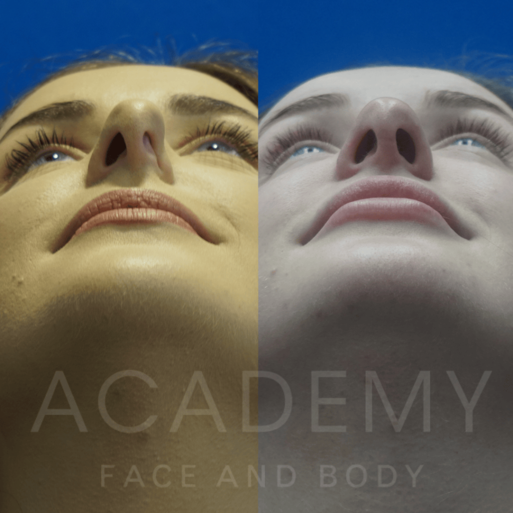 academy-face-and-body-NOSE-4