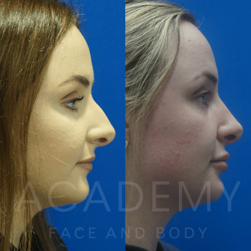 academy-face-and-body-NOSE-5