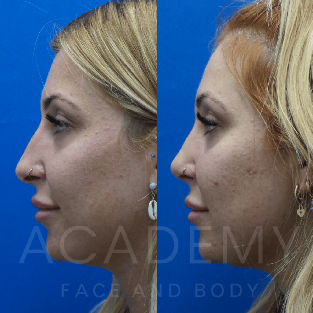 academy-face-and-body-NOSE-6