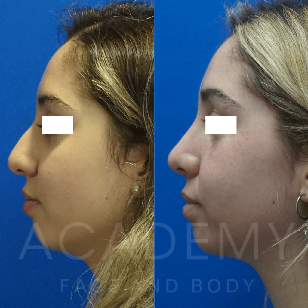 academy-face-and-body-NOSE-7