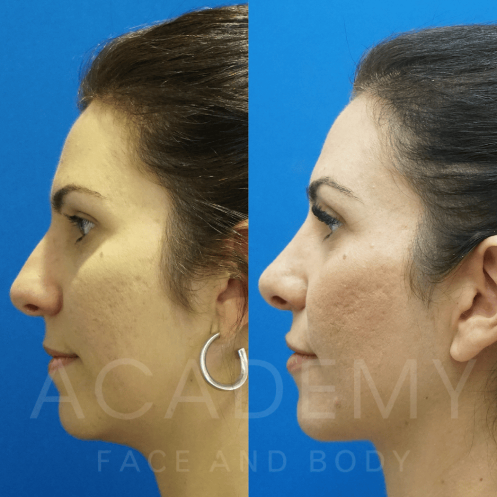 academy-face-and-body-NOSE-9